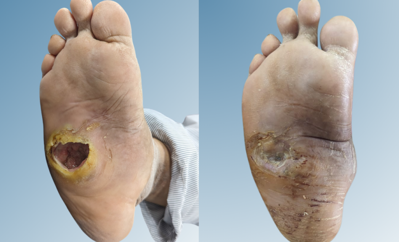 Diabetic Foot Care: Why Early Treatment Matters – Amble Foot & Ankle Centre, Ahmedabad