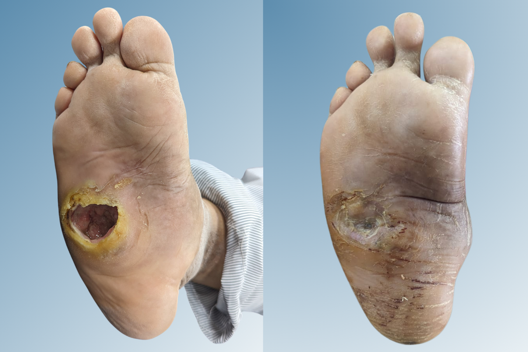 Diabetic Foot Care: Why Early Treatment Matters – Amble Foot & Ankle Centre, Ahmedabad