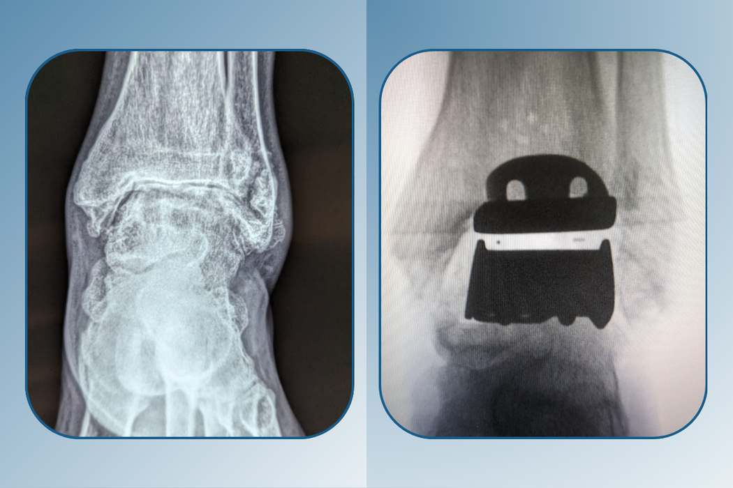 Total Ankle Replacement in Ahmedabad